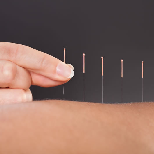 Akupunktur-Nadeln im Rücken