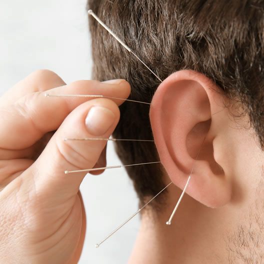 Ohrapunktur - Akupunktur-Nadeln im Ohr